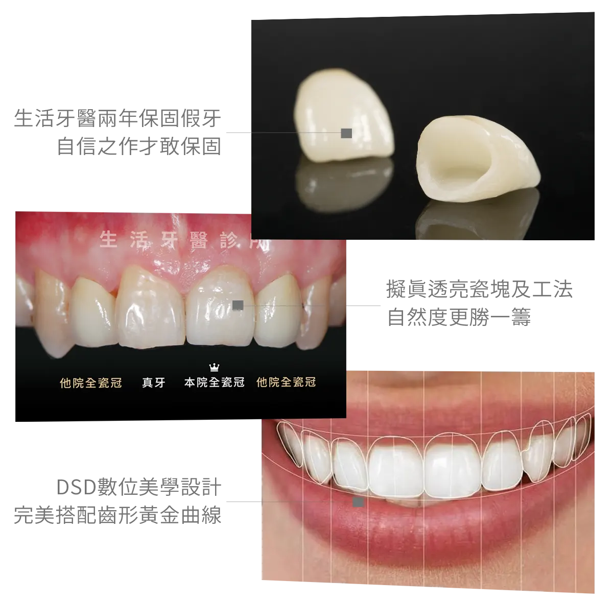 台中南投生活牙醫生活牙醫全瓷冠自然透光與牙齒修復效果